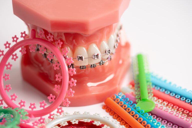 warna braces cantik