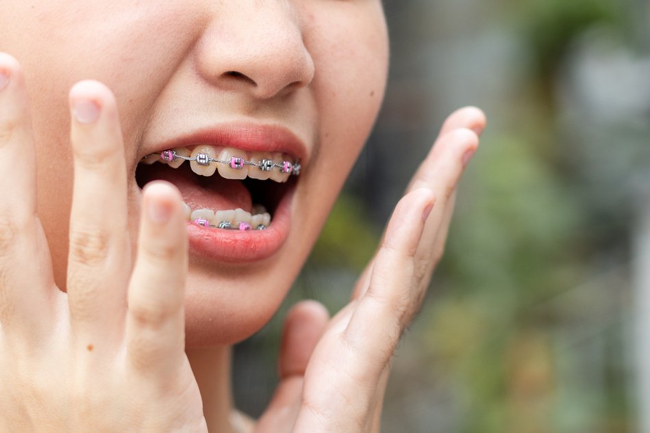 young female beautiful smile with braces close up 2024 02 02 17 19 40 utc 1