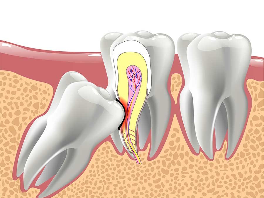 impacted wisdom tooth 2