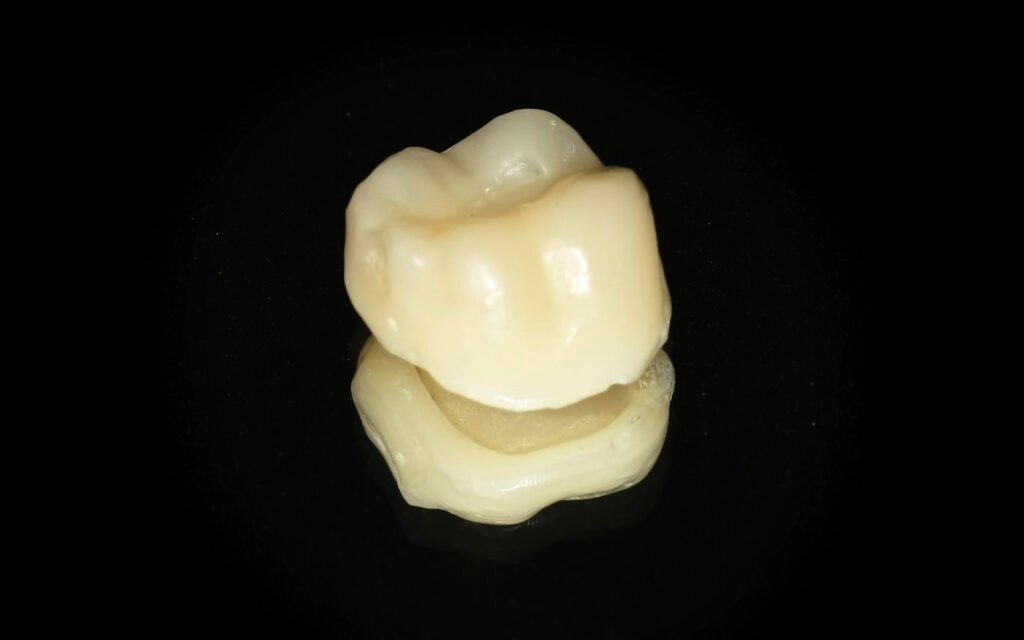 composite veneer