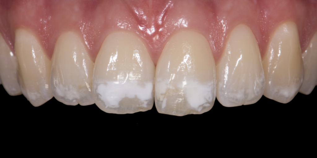 White Spots on Teeth