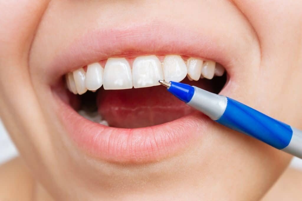 white spots on teeth causes treatment and prevention 1024x683 1 rotated