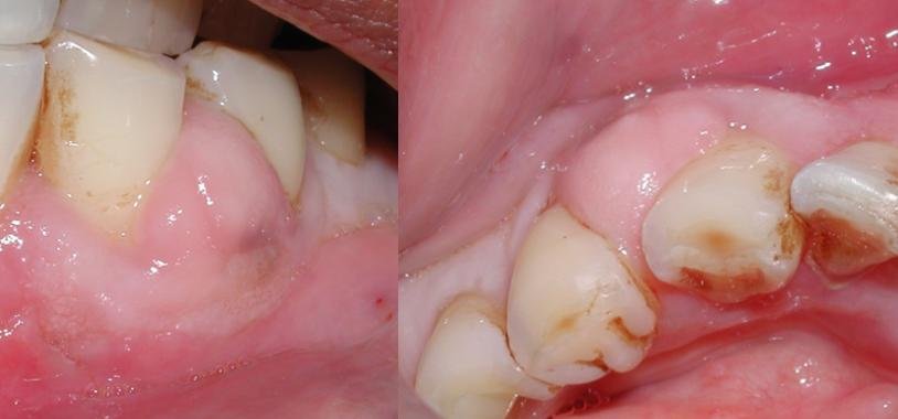 dental abscess gusi bernanah